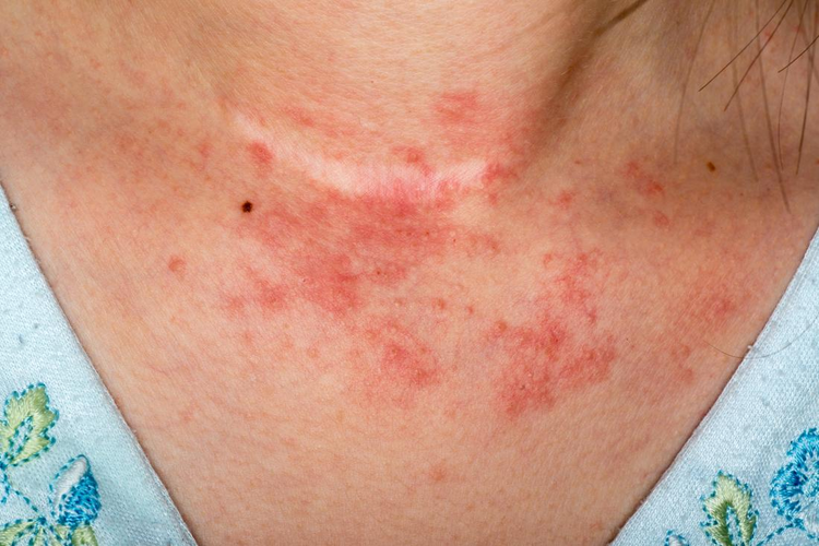 DERMATITIS ATÓPICA, ECZEMA
