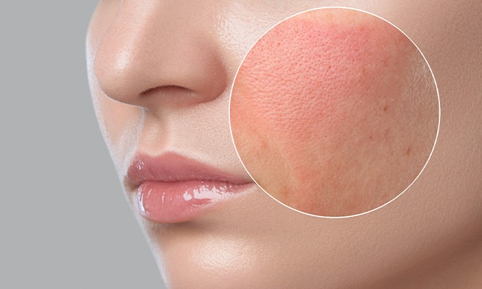 PIEL SENSIBLE, ROSÁCEA