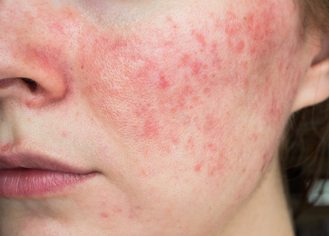 Rosacea y Sensibilidad